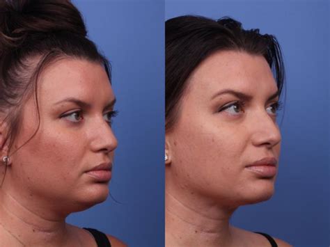 Liposuction In Scottsdale, AZ .